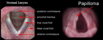 papilloma_comparison - UC Davis Center for Voice and SwallowingUC Davis