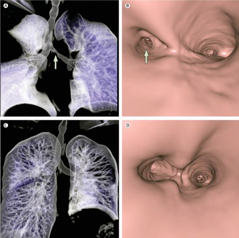 CIRM Grant for regenerative airway reconstruction